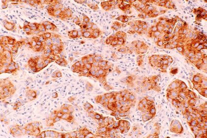 Breast cancer, image via National Cancer Institute on Unsplash