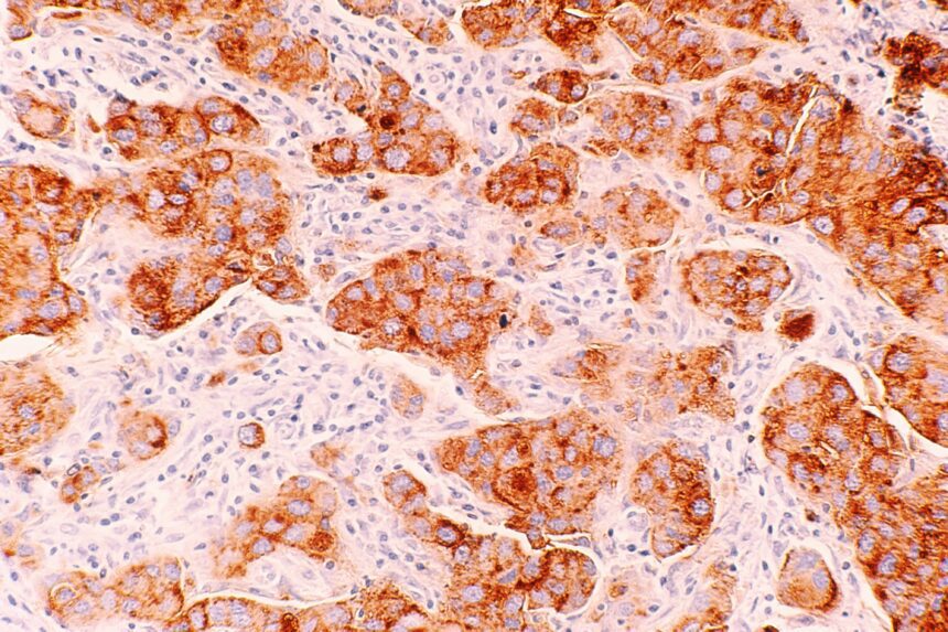 Breast cancer, image via National Cancer Institute on Unsplash